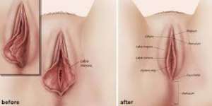 Vagina vernauwing en schaamlipcorrectie